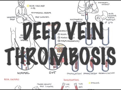 Deep Vein Thrombosis - Overview (pathophysiology, treatment, complications) thumbnail