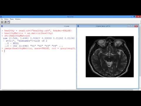 6.4.6 R6. Segmenting Images - Video 4: MRI Image thumbnail