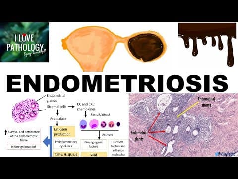 ENDOMETRIOSIS: Etiopathogenesis, Cinical features and Pathology thumbnail