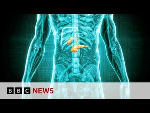 Detecting ‘hidden’ pancreatic cancer cases | BBC News thumbnail