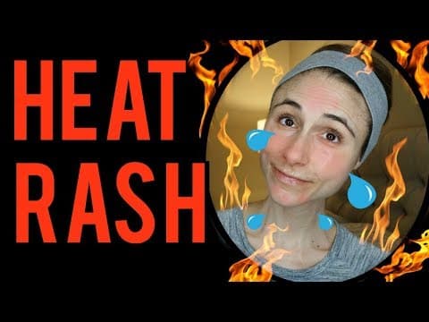 What Causes Heat Rash and How Can You Prevent It? thumbnail