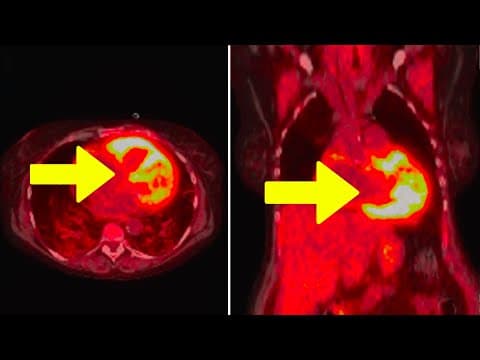 Young Man Takes Brand-New Vitamin K2 Supplement. This Happened To His Heart... thumbnail