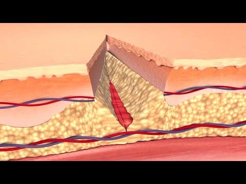 How Your Body Heals Cuts, Scrapes, and Puncture Wounds to the Skin thumbnail