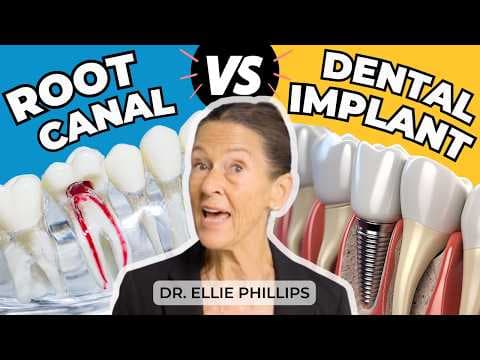 Root Canals vs Dental Implants: Which is Better for You? thumbnail
