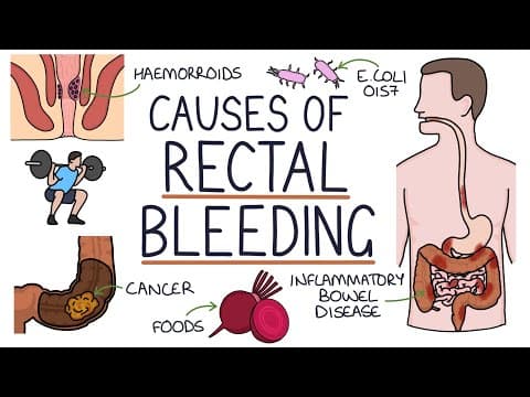 Understanding the Causes of Blood in Stool (Rectal Bleeding) thumbnail