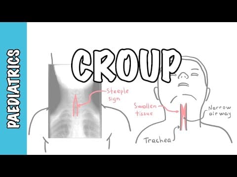 What is Croup (larynotracheobronchitis) - symptoms, pathophysiology, investigations, treatment thumbnail