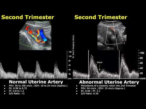 Uterine Artery Spectral Doppler Ultrasound Normal Vs Abnormal Images | Pregnant/Nongravid Uterus USG thumbnail