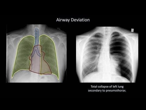 How to Interpret a Chest X-Ray (Lesson 4 - Airways, Bones, and Soft Tissues) thumbnail