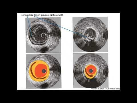 Intravascular ultrasound (IVUS) - Elias Hanna, Univ of Iowa thumbnail