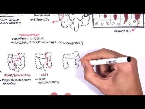 Colorectal Cancer - Overview thumbnail