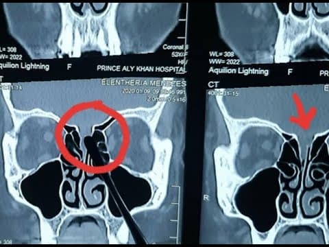 MENINGOCELE- Cribriform CSF leak explained on CT PNS . CT PNS made simple A to Z. Dr.Ajinkya Kedari thumbnail