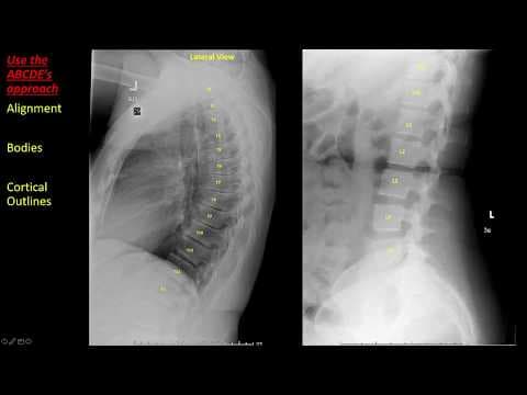 Introduction to Spine Radiographs thumbnail
