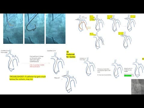 Left EBU/CLS guides manipulations, radial and femoral +Ikari L +Key tips in left coronary engagement thumbnail