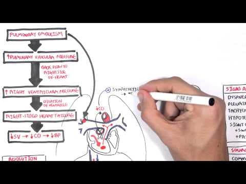 Pulmonary Embolism PART I (Overview) thumbnail