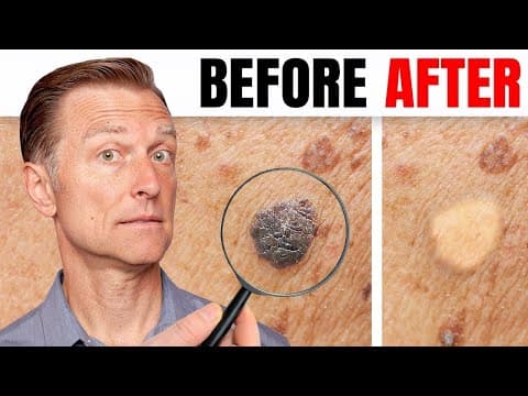 How to Remove Skin Tags and Warts Overnight - Dr. Berg Explains thumbnail