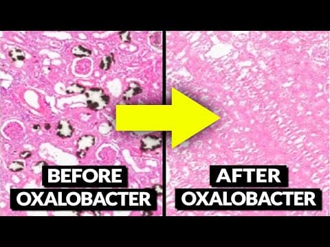 We Finally Know How To Block Oxalate Absorption In The Gut thumbnail