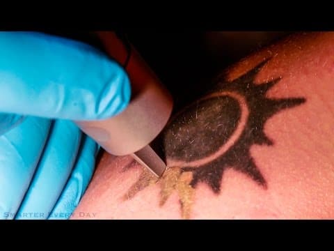 How Does Laser Tattoo Removal Work? thumbnail