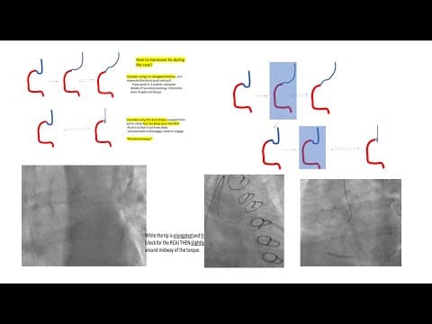 Amplatz L guide manipulations/videos- Other RCA guides and tips- The 5 RCA engagement caveats- Hanna thumbnail