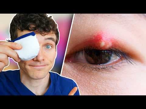 How to Treat a Stye at Home & When to See a Doctor thumbnail