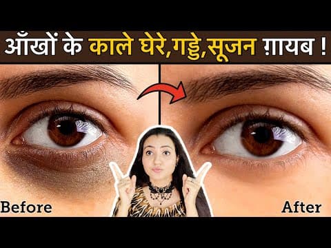 In 7 Days 💕 Remove DARK CIRCLES काले घेरे, PUFFY EYES, गड्ढे SUNKEN EYES Naturally | 100% Results thumbnail