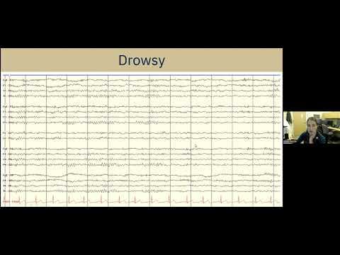 Understanding EEG: A Practical Guide for Patients and Families thumbnail