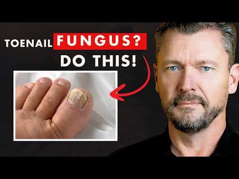 CURE Toenail Fungus (And keep it Gone FOREVER) thumbnail
