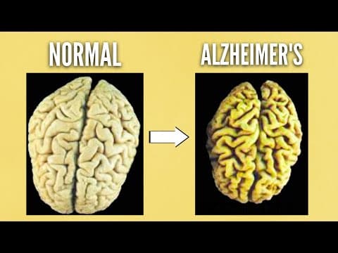 The BIGGEST  reason people get Alzheimer's Disease (DEMENTIA) thumbnail