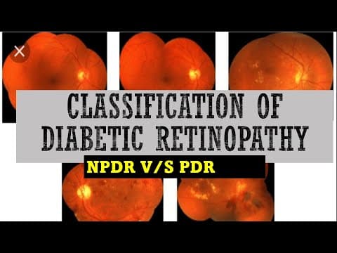 STAGES of DIABETIC RETINOPATHY || mild, moderate, severe NPDR vs PDR thumbnail
