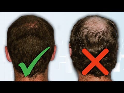 Hair Loss is NOT just Genetics? (They are twins) thumbnail