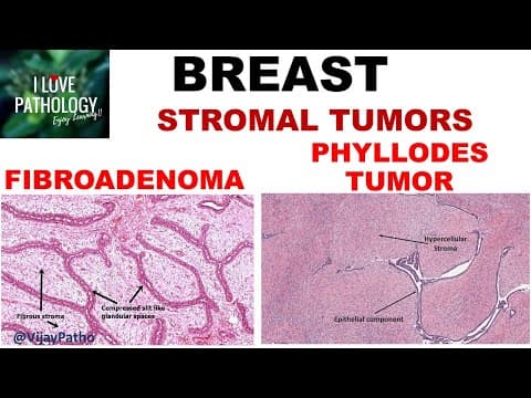 Diseases of Breast: Part 3: Fibroadenoma & Phyllodes tumor thumbnail