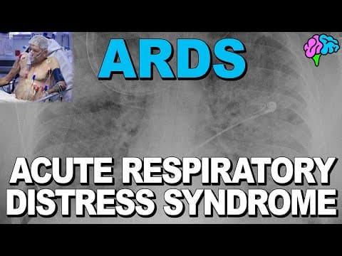 What is ARDS? Acute Respiratory Distress Syndrome thumbnail