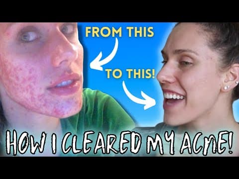 HOW I CLEARED MY ACNE ( Chronic, Cystic, Digestive, Hormonal) thumbnail