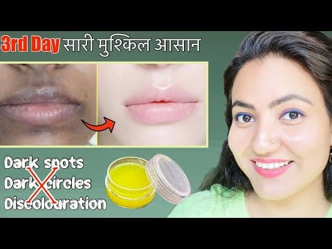 Skin Transformation Challenge (Day 3) : Remove Dark Spots, Dark Circles & Dark Patches Around Mouth thumbnail