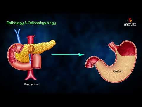 Zollinger-Ellison syndrome (ZES) - Animated lecture usmle step 1 pathology , Dr Bhanu prakash thumbnail