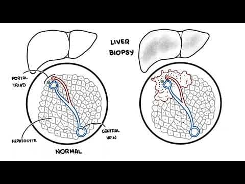 What Causes Autoimmune Hepatitis and How Is It Treated? thumbnail