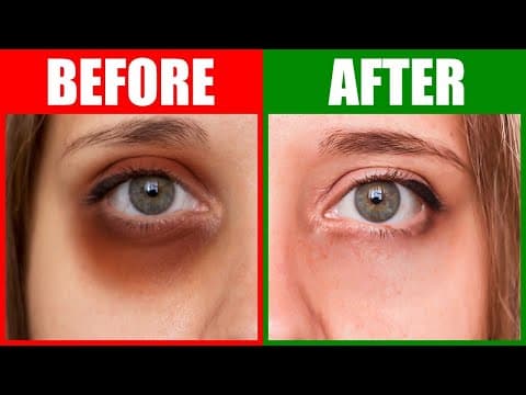 Fix the Root Cause of Dark Circles Under the Eyes thumbnail