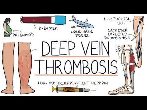 Understanding Deep Vein Thrombosis (DVT) thumbnail