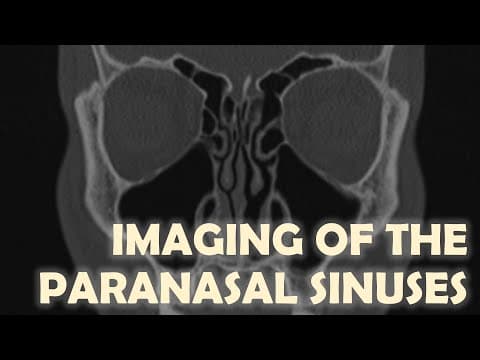 Imaging Anatomy of the Paranasal Sinuses thumbnail