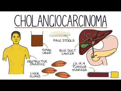 Understanding Cholangiocarcinoma thumbnail