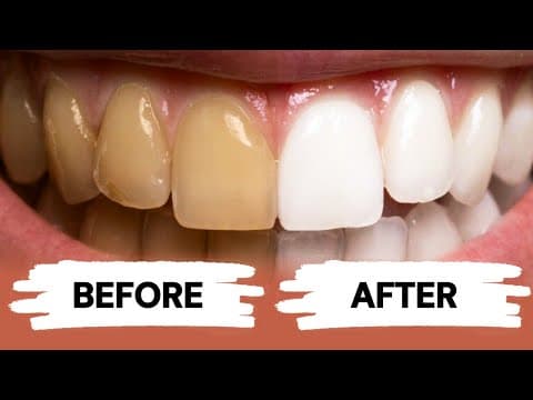 Teeth Whitening at Home thumbnail