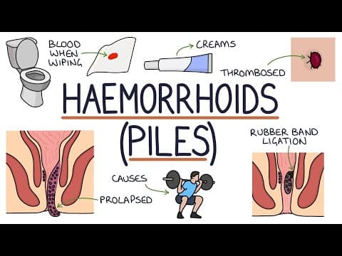 Understanding Haemorrhoids thumbnail