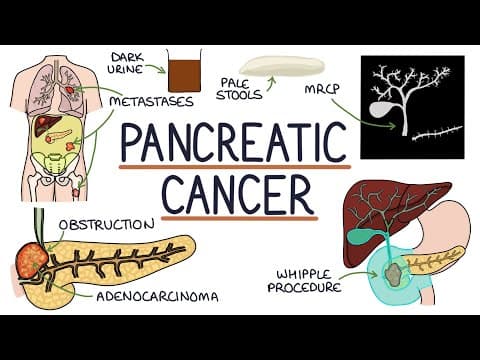 Understanding Pancreatic Cancer thumbnail