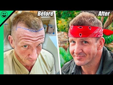 $3000 Thai Hair Transplant!! Was This a Mistake?? thumbnail