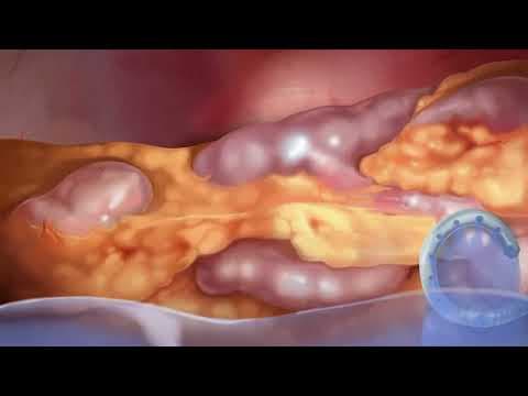 What is Peritoneal Dialysis? thumbnail