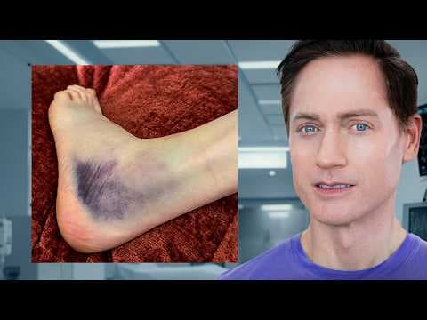 How Fast Can You Heal a Sprained Ankle Fracture? thumbnail