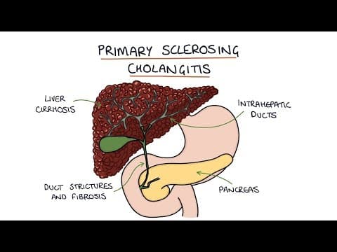 Primary Sclerosing Cholangitis: Visual Explanation for Students thumbnail