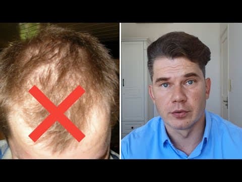 No Transplant, Just Rogaine – Here’s How I Got Real Regrowth thumbnail