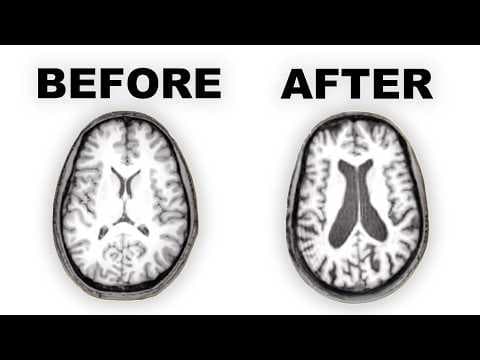 Long-term Effects of Antipsychotics on the Brain thumbnail