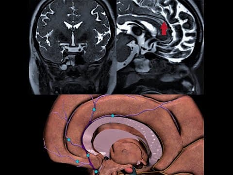 ANTERIOR CEREBRAL ARTERY | RECURRENT ARTERY OF HEUBNER | MRI BASICS | ANATOMY thumbnail