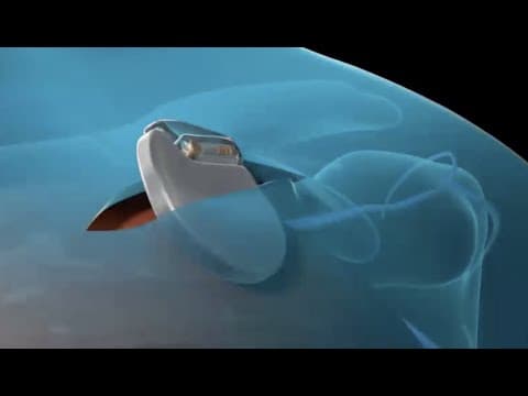 Pacemaker thumbnail